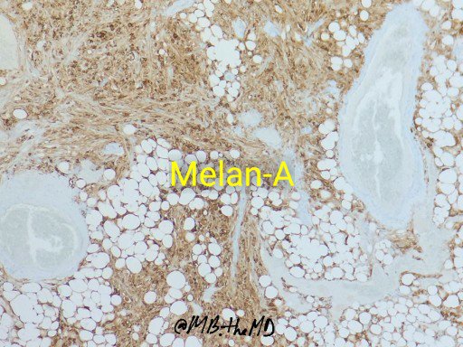 MB_thepathMD's tweet photo. And the answers are: #pathology #pathresident #GIpath #pathart #pathcases https://t.co/CmIiLI9lqJ