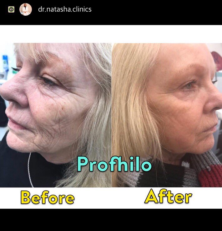 #Profhilo #bioremodelling #collagen #elastin #skin #skinquality #skinlaxity #hyaluronicacid #antiageing  #gamechanger #lovedbypatients #IBSA