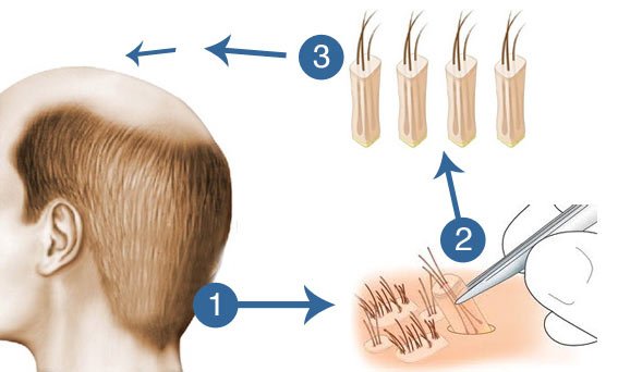 softesthetique's tweet photo. #GREFFE DE #CHEVEUX
#MICRO #GREFFE_FUE
par #Dr_Mourad_Zinelabidine
https://t.co/ABmYGDruW8 https://t.co/pmcz33rRyQ