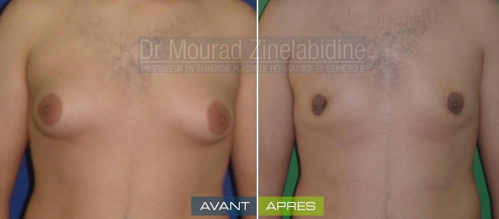 softesthetique's tweet photo. #CHIRURGIE #SEINS
#GYNECOMASTIE #TUNISIE
par #Dr_Mourad_Zinelabidine
https://t.co/zN5K5oq7zH https://t.co/e0Ur6pqKyW