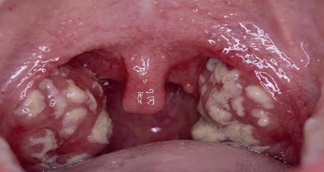 من خبرة ..شاهد أسرع 4 مشروبات لعلاج التهابات اللوزتين - التفاصيل: goo.gl/sZLbkA