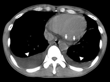 Acute heart failure associated with human parvovirus B19 infection
onlinelibrary.wiley.com/doi/10.1111/j.…
Patient with acute heart failure due to human parvovirus B19 infection. The patient was a 36-year-old man with polyarthralgia, fatigue and swelling of his upper eyelids and all four limbs