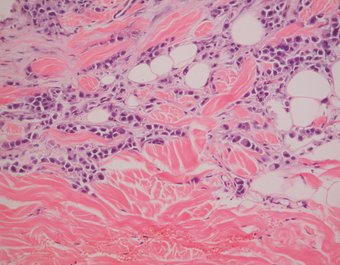 An indurated plaque on the chest and breasts
onlinelibrary.wiley.com/doi/10.1111/j.…
What's the diagnosis?