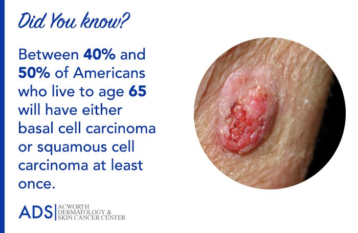 Did You Know?
Between 40% and 50% of Americans who live to age 65 will have either basal cell carcinoma or squamous cell carcinoma at least once. #carcinoma #skincancer #skincare #Skincarefacts