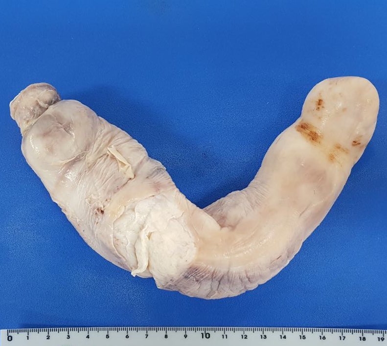 Intravenous leiomyoma(tosis). This tumor were extending from right iliac vein through thoracic inferior vena cava. #pathology