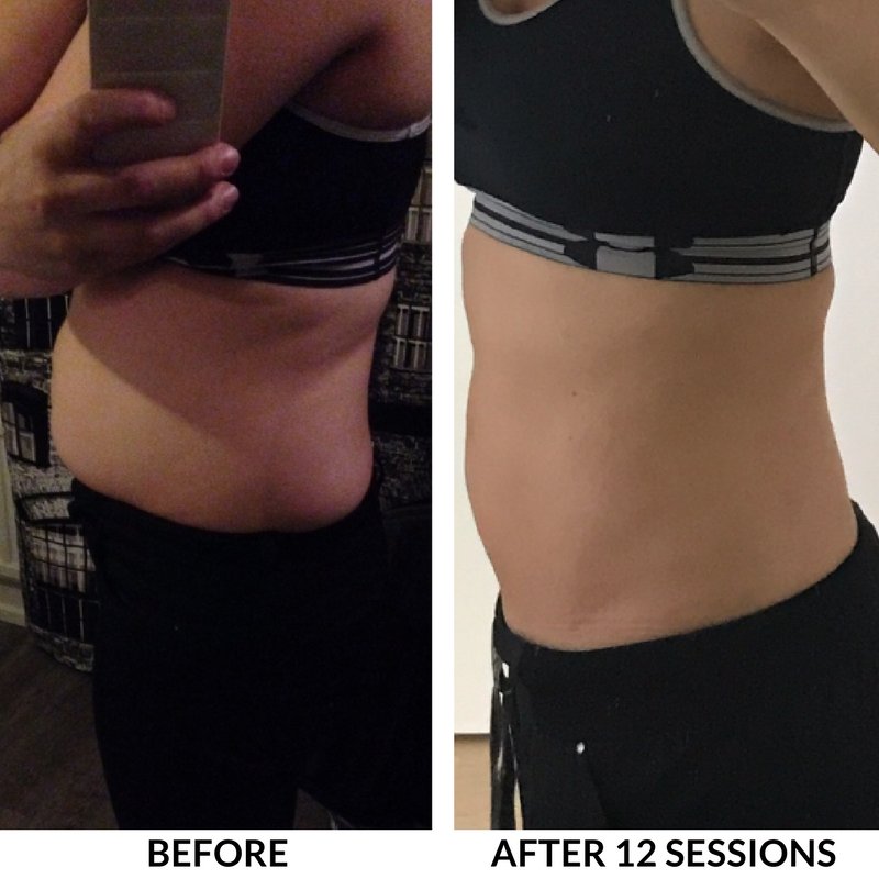 ReduStim_ME's tweet photo. Transformation before &amp; after 12 sessions of ReduStim Medical device for the reduction of health risks related to excess in abdominal fat
Are you suffring from strong obesity with difficulty to produce physical effort &amp; looking lose up some garment sizes?
https://t.co/i0XrBkw8BW https://t.co/8wX6XjDzPR