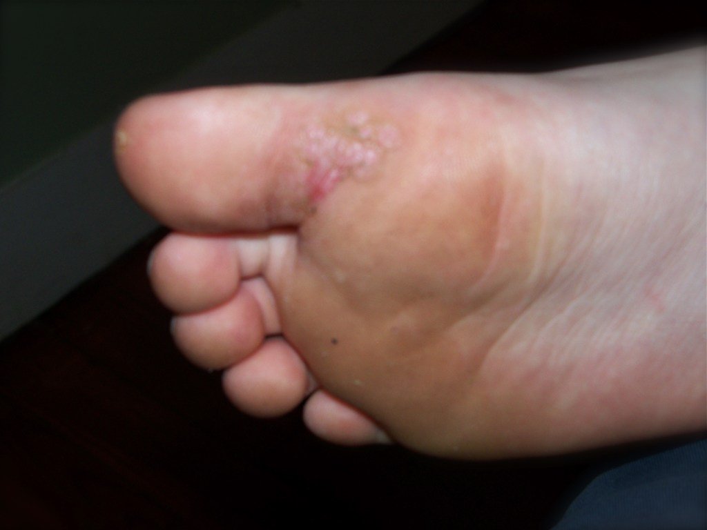 Wart_Guru's tweet photo. Mosaic Warts and Related Facts https://t.co/i6uqNLK6DU https://t.co/J4lCErr3Lm