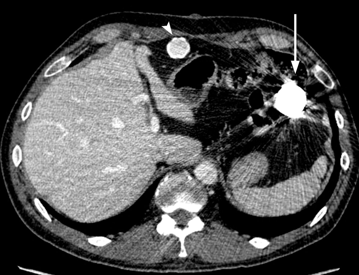 Decide how to reduce metal artifacts at CT with projection-based MAR algorithms or the dual-energy CT technique.  bit.ly/2p7Cxk2 #radiology
