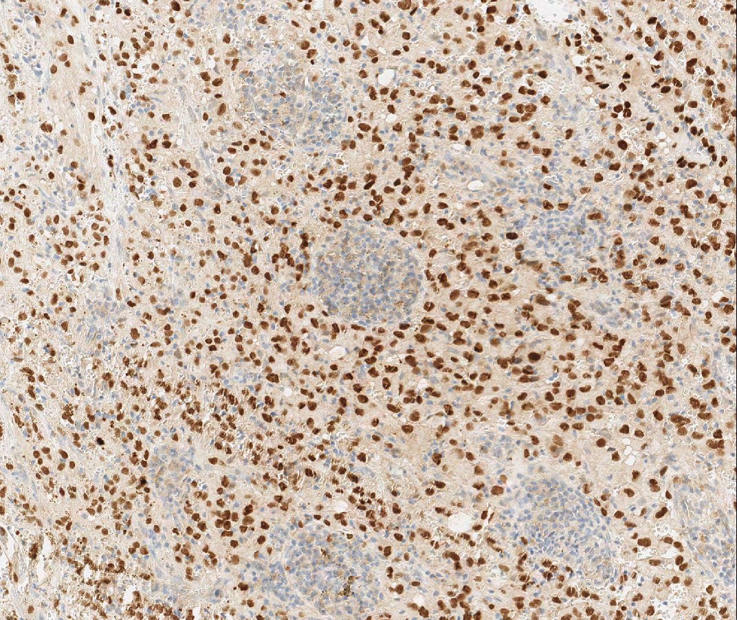 TFE-3 positive Epithelioid hemangioendothelioma. IHC pictures are CD31 and TFE-3. They can be more vasoformative and have locoregional spread but seem to keep the indolent behavior of coventional EHE. #Pathology @SBPatologia @PathologySBP