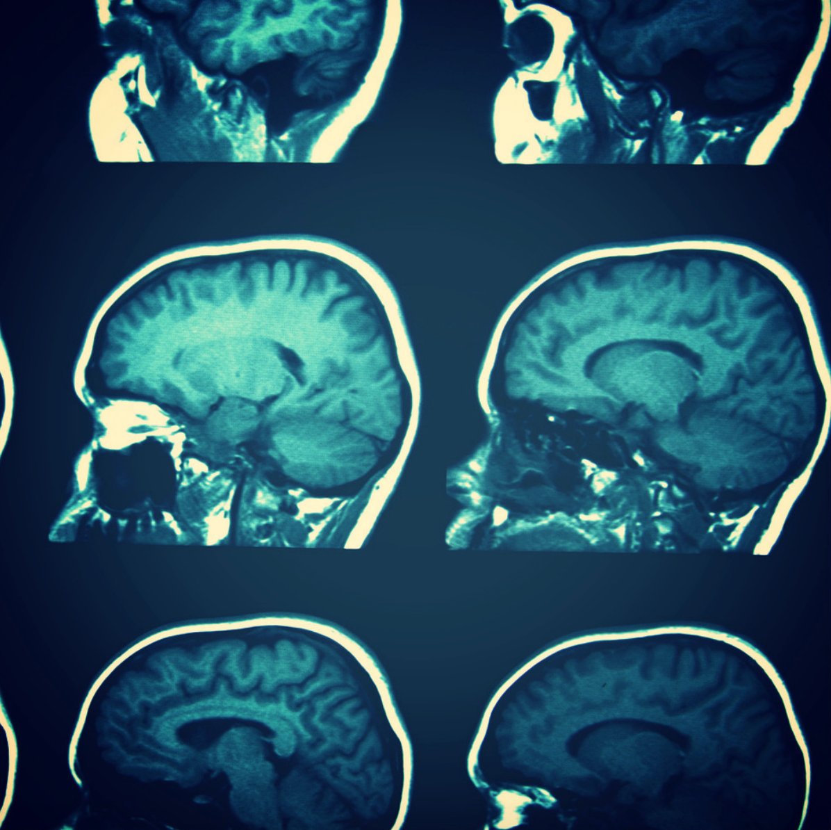 BioSkyNews's tweet photo. A new marker for Chronic Traumatic Encelopathy (#CTE) may allow #diagnosis while the sufferer is still alive. 

Read about the study here: https://t.co/TysDhn6nPM

#brain #BrainAwarenessWeek 🧠 https://t.co/l6aNetL5sC
