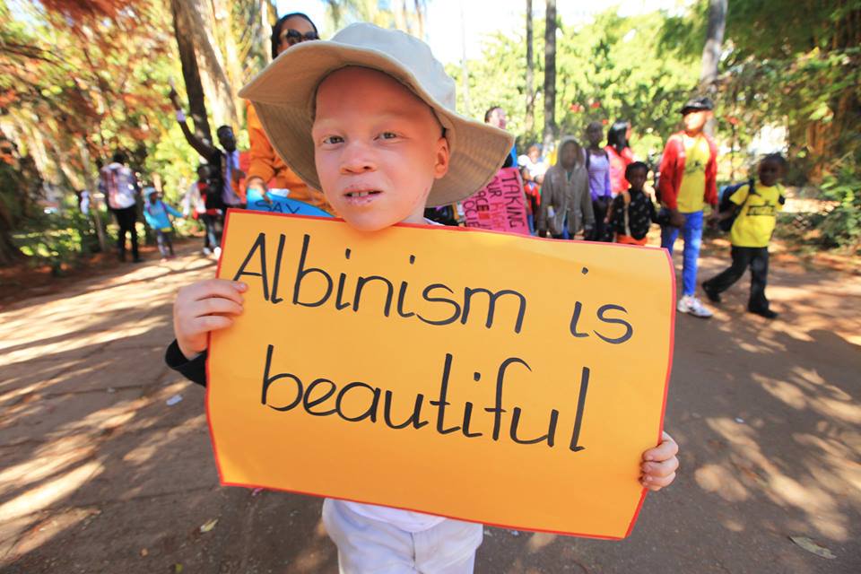 RT Let's make this trend. #Albinism