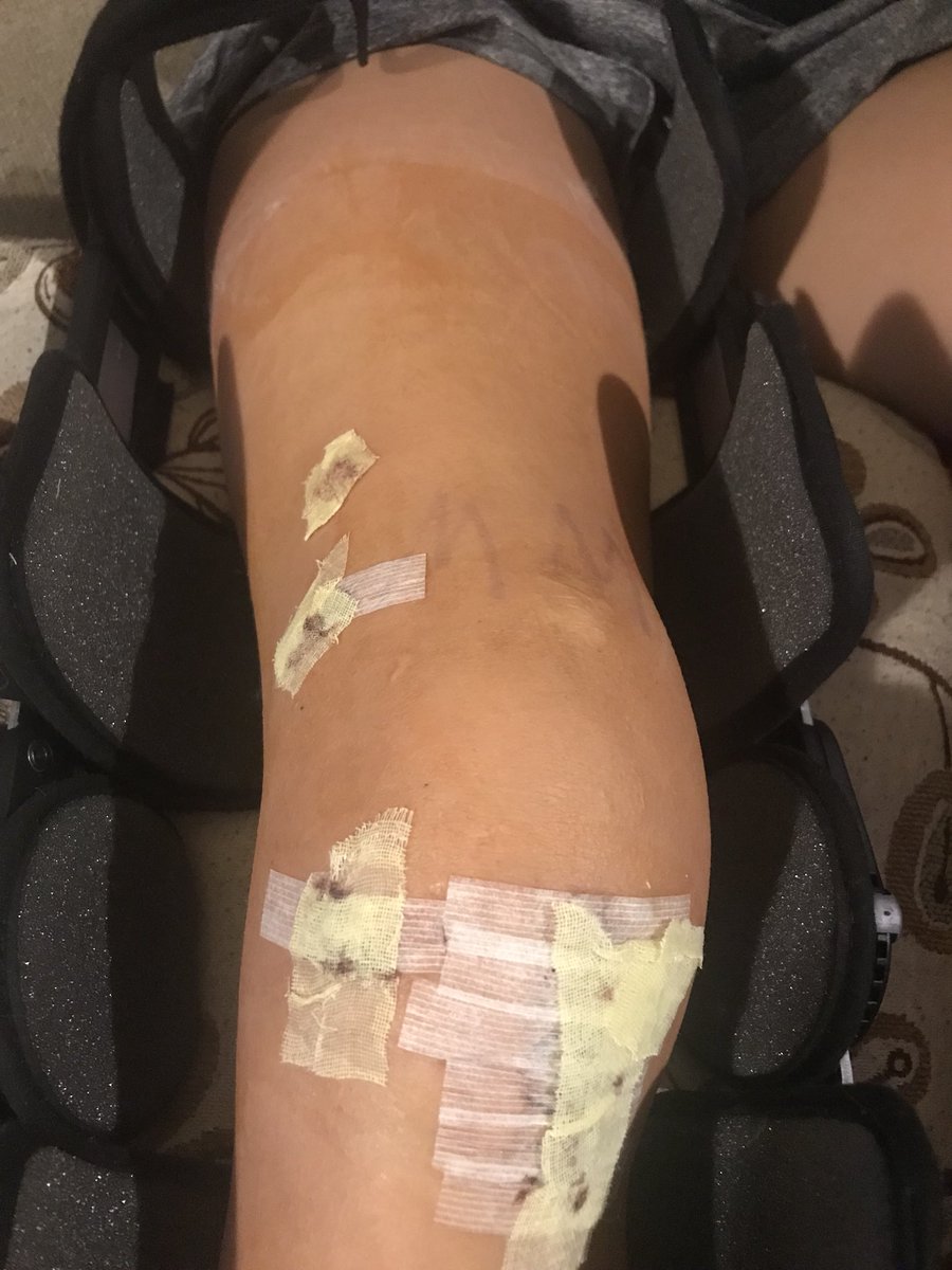 JourneyGenesis1's tweet photo. Unwrappped the knee two days ago. CPM machine twice a day and therapy three times a week. On the road to recovery because this baller has things to do!! #Senioryeargoal https://t.co/DaZjs6F8uG