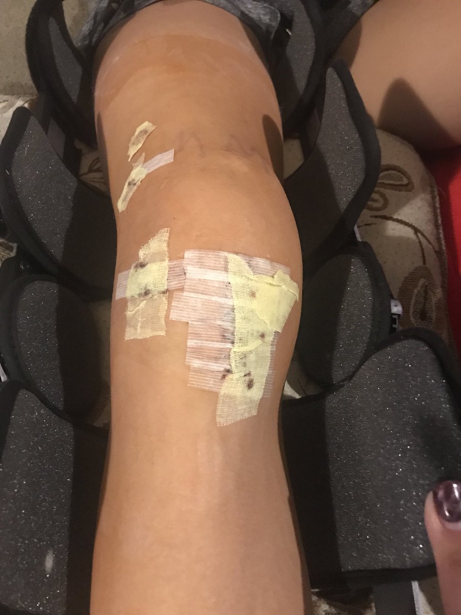 JourneyGenesis1's tweet photo. Unwrappped the knee two days ago. CPM machine twice a day and therapy three times a week. On the road to recovery because this baller has things to do!! #Senioryeargoal https://t.co/DaZjs6F8uG