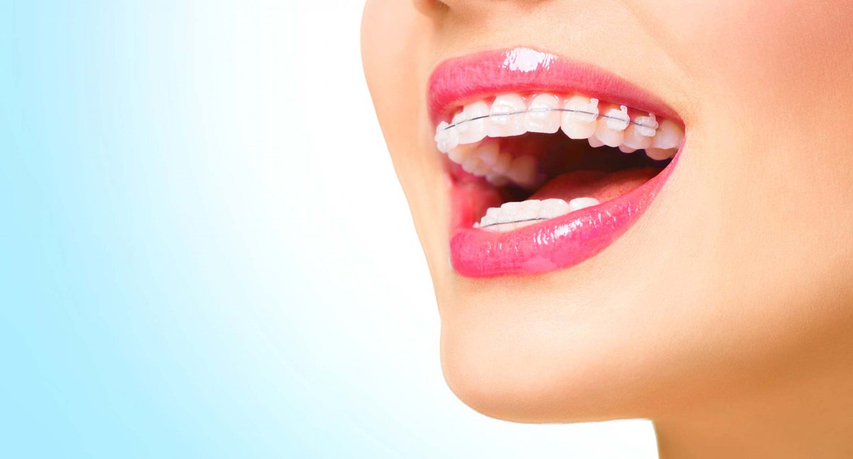 Dominion_Dental's tweet photo. Are you looking for fast, affordable teeth straightening? Come talk to us about the different options available!

https://t.co/4hoP8IhYrz

#fastbrtaces #braces #orthodontics #auckland #mtroskill #nz https://t.co/WuFjuZaiJp