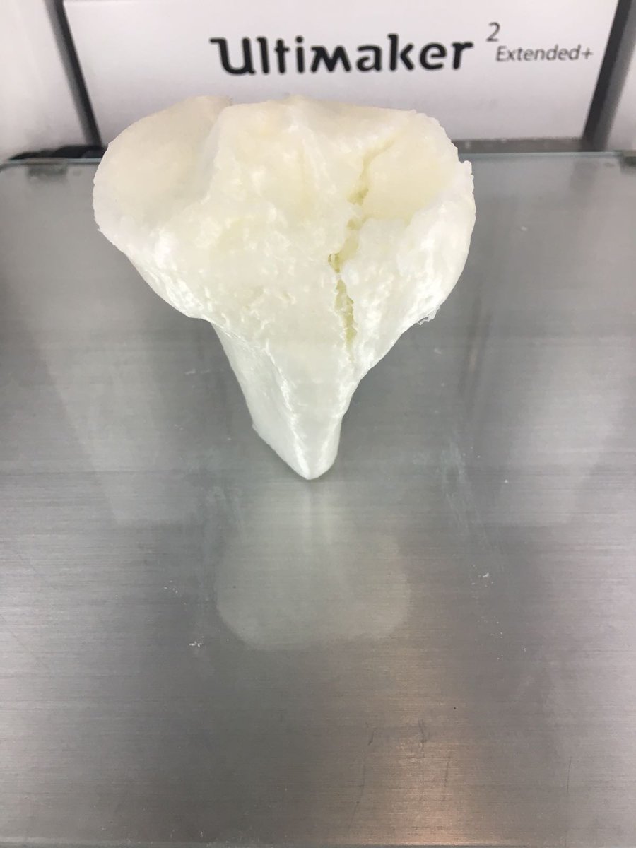 GabrielBME (@3dgabbme) on Twitter photo Cost effective 3D print of an external fracture on the tibial plateau on an ultimaker 2 extended with smart glow. Look how it glows in the dark!!
<a href="/rupermac/">Rubén Pérez-Mañanes, MD PhD</a> <a href="/calvoharo_ja/">José Antonio Calvo</a> <a href="/CharlieMonitor/">Charlie Molitor</a> <a href="/3d_maranon/">FabLab 3D Hospital Marañón</a> <a href="/Ultimaker/">UltiMaker</a> Cost effective 3D print of an external fracture on the tibial plateau on an ultimaker 2 extended with smart glow. Look how it glows in the dark!!
<a href="/rupermac/">Rubén Pérez-Mañanes, MD PhD</a> <a href="/calvoharo_ja/">José Antonio Calvo</a> <a href="/CharlieMonitor/">Charlie Molitor</a> <a href="/3d_maranon/">FabLab 3D Hospital Marañón</a> <a href="/Ultimaker/">UltiMaker</a>