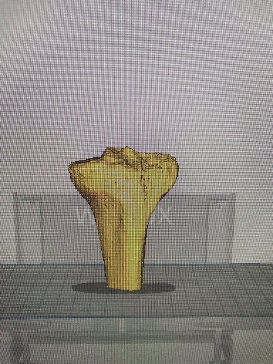 CharlieMonitor's tweet photo. Cost effective 3D model of an external fracture on the tibial plateau printed on a BQ Witbox 2. Printer was subject to colder temperatures during printing causing the bad adhesion toward the end. @3d_maranon @rupermac @calvoharo_ja @BiomedAdrian @BiomedEstefania @3DGabBME https://t.co/KxLPkfJmPT