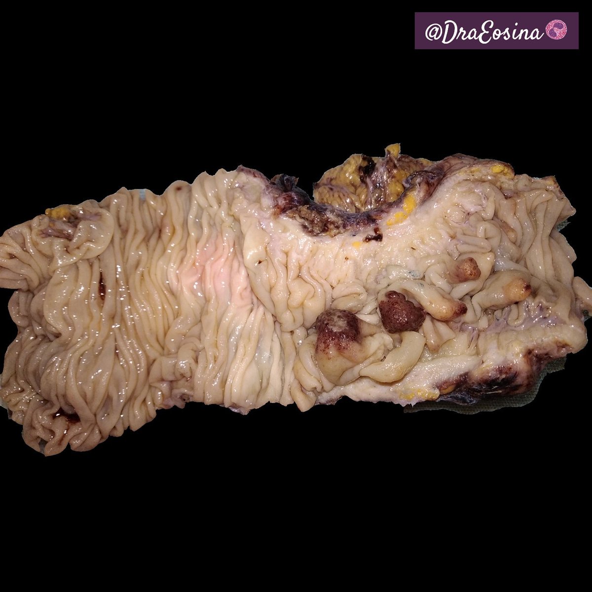 DraEosina's tweet photo. #Grossognosis challenge. What's your bet for these polyps?
#GIPath #GrossPath #Pathology
Perfectly grossed by @i_erizo #Paz_Path https://t.co/Rnc4cezXsy