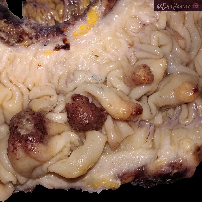 DraEosina's tweet photo. #Grossognosis challenge. What's your bet for these polyps?
#GIPath #GrossPath #Pathology
Perfectly grossed by @i_erizo #Paz_Path https://t.co/Rnc4cezXsy