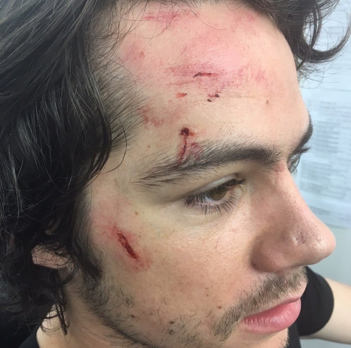 newtmaspower's tweet photo. Cabelo sedoso
Pele de porcelana
Sobrancelhas grossas divinas
Olhos castanhos profundos 
Barba meio rala
Lábios rosados 
Narizinho de elfo
Caracterização: príncipe machucado

CARALHO DYLAN,VC É UM ASSASINO DA PORRA! https://t.co/QM22WmM0uN