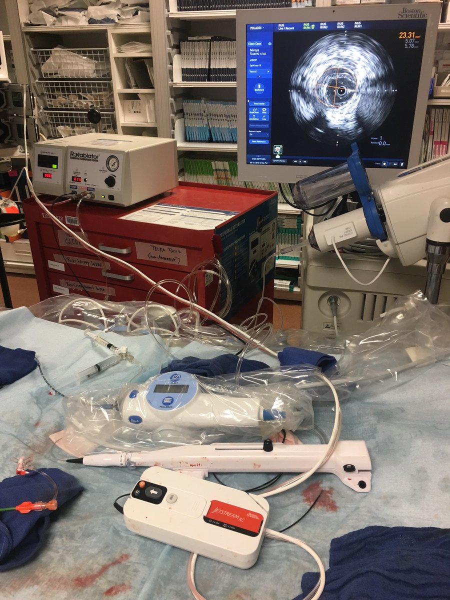 drsavealimb's tweet image. RV CLI, #CTOP 4 SFA &amp;amp; AT, retrograde intraluminal crossing with Halberd-18, antegrade #jetstream with NAV-6 &amp;amp; retrograde #rotablator for #IVUS guided SFA and tibiopedal reconstruction @SOBE_Vascular @Mustapja @SDhandMD @FadiSaab17 @kmadass @SriniTummala #CLIFighters @bsc_pi