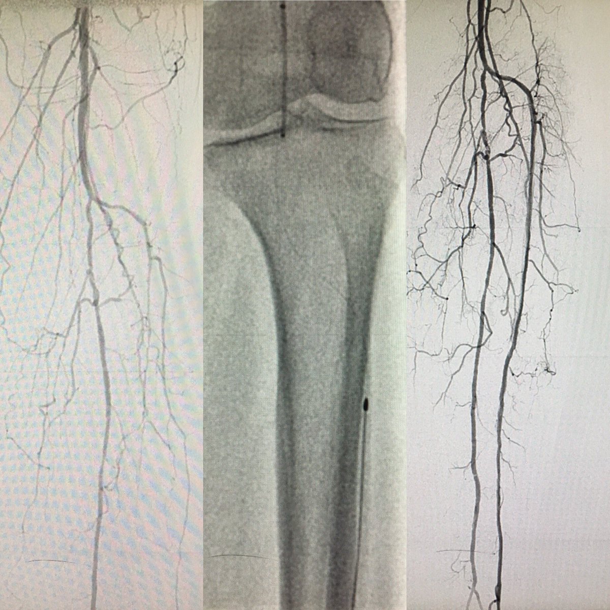 drsavealimb's tweet image. RV CLI, #CTOP 4 SFA &amp;amp; AT, retrograde intraluminal crossing with Halberd-18, antegrade #jetstream with NAV-6 &amp;amp; retrograde #rotablator for #IVUS guided SFA and tibiopedal reconstruction @SOBE_Vascular @Mustapja @SDhandMD @FadiSaab17 @kmadass @SriniTummala #CLIFighters @bsc_pi