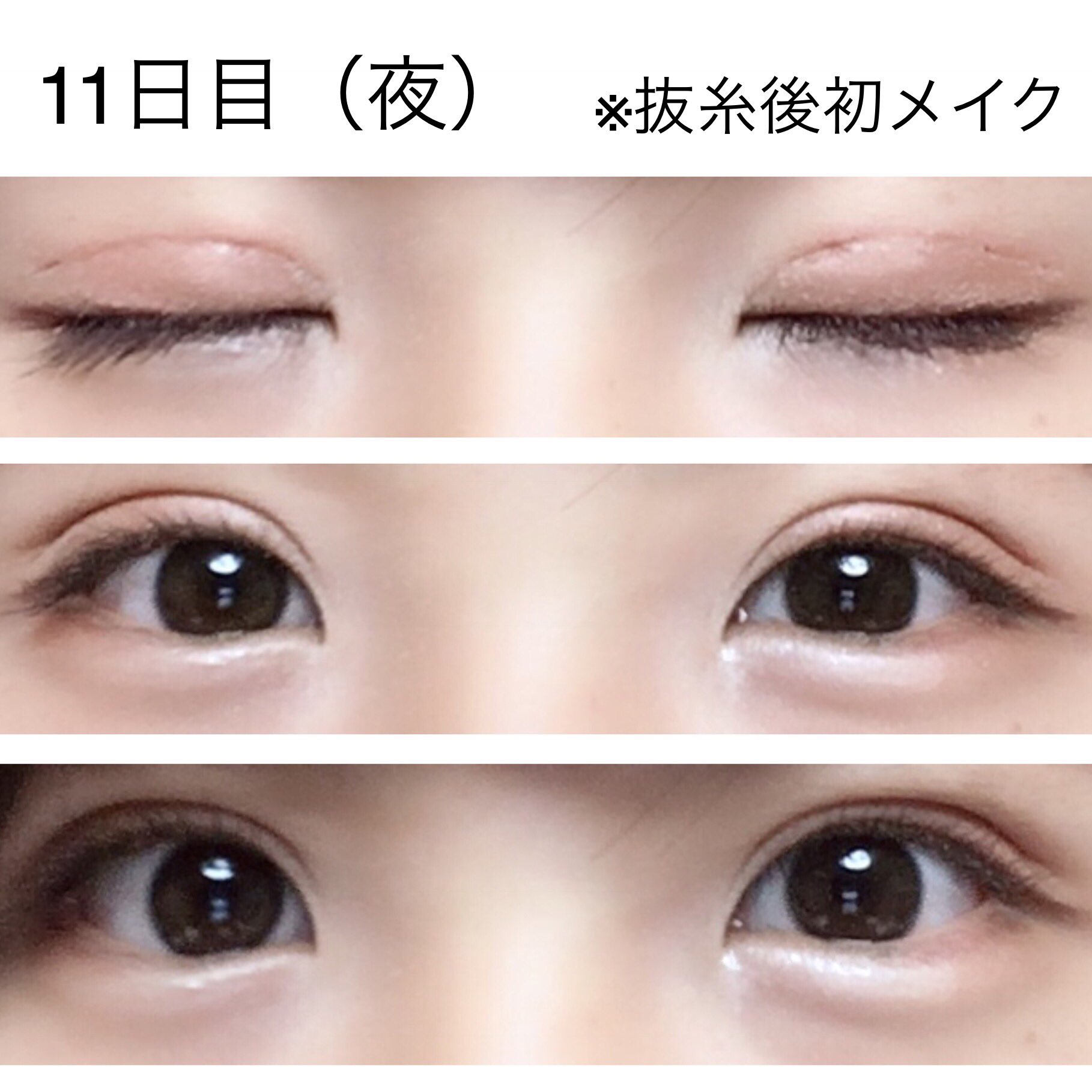 もも水 Pa Twitter 二重全切開 11日目 朝写真撮り忘れました 閉眼時も自然に見えなくもないですが 実際は脂肪が乗っかってちょっと食い込んだ感じになります まだ瞼の感覚ないしアイメイクがデコボコするけど周りからはバレない程度 だと思います 切開線の