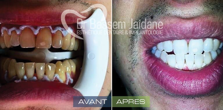 softesthetique's tweet photo. #SOINS #DENTAIRES
#BLANCHIMENT #DENTAIRES #TUNISIE
par #Dr_Bassem_Jaidane
https://t.co/TolJZ4vp94 https://t.co/TAQPuvLD9Z