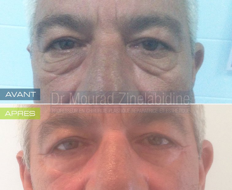softesthetique's tweet photo. #CHIRURGIE #VISAGE
#BLEPHAROPLASTIE #TUNISIE
par #Dr_Mourad_Zinelabidine
https://t.co/wKw22XRosk https://t.co/y0jOcVMBPL