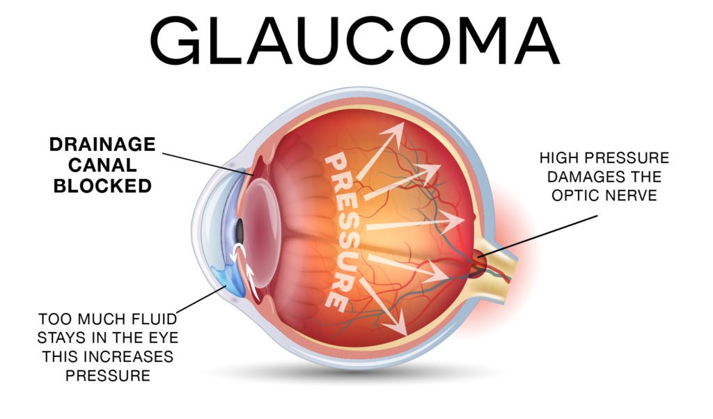 USCEye's tweet photo. Do you know the signs of #angleclosure #glaucoma? With a blocked #drainage angle, the #symptoms are much more #prevalent than #openangle glaucoma. Familiarize yourself and schedule an #appointment if any of the following symptoms apply. #wgw2018
https://t.co/Fw7LZj4geC https://t.co/Qo3ocQuPVG