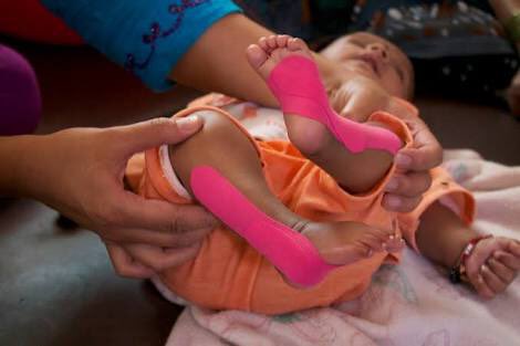 FindPhysio's tweet photo. Gone are those days when surgery was the main stay of treatment and people just couldn't afford it

Today, Physiotherapy is the first line of treatment for club foot deformity

See results 

#findphysio #naija #nigeria https://t.co/ogvvn1SWEU