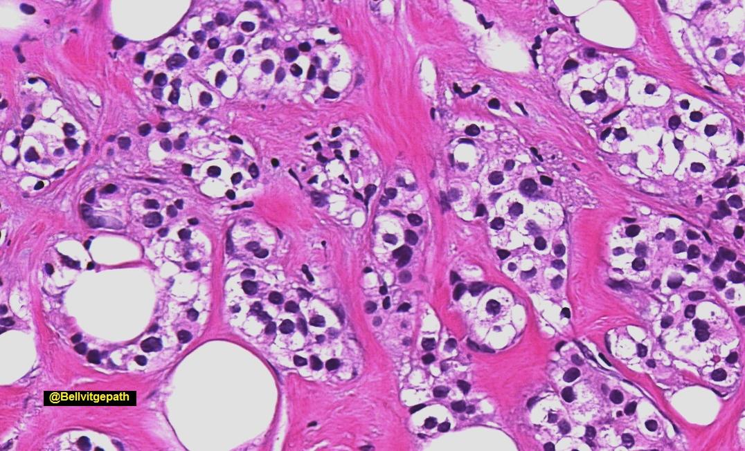 bellvitgepath's tweet photo. Clear skies outside, clear cells inside. Breast core biopsy in a middle aged female. What do you think should be done next? #pathology #breatspathology #BreastPath #clearcells https://t.co/i4mncPGswt