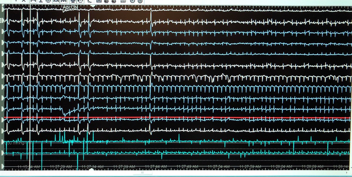 44yo with NICM, LVEF 30% referred for ICD. ECG in office shows frequent interpolated PVCs. 23% burden. Successful RVOT ablation today, and perhaps no ICD. A reminder of need to raise awareness of PVC cardiomyopathy outside EP circles @narrowQRS @PittCardiology @jelevenson