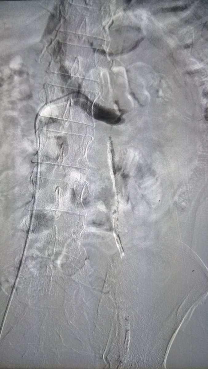 Embolisation for Varicocele, TUTH, Nepal.