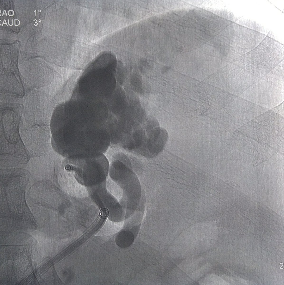 BRTO at TUTH #IAMIR, #Interventionalradiology