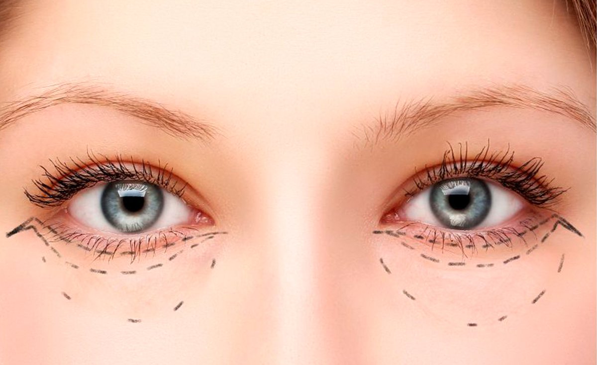 NatlHealthNews's tweet photo. "How Much Does an Eyelid Lift (#Blepharoplasty) Cost on Long Island?" by @nseye https://t.co/h66oXX9rph https://t.co/upkXPLRdMx