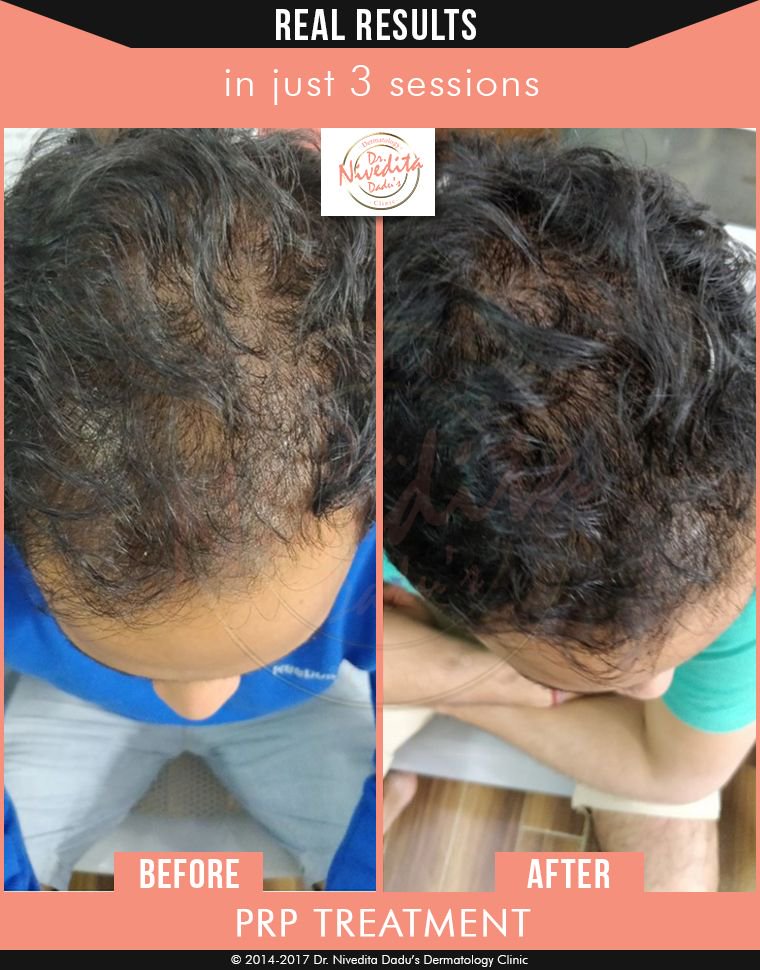 Transform Your Hair: 3-Month Prp Before and After