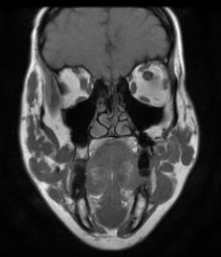 Rad_Bits's tweet photo. Quiz216: thoughts?
#طلاب_الطب #radiology #kku_med #uqumed #UQUMed35 #bu_medicine #Meded #mededu #radiology #Medstudent #medstudents #med10 #med13 #med19 #med14 #med11 #imed15 #imed16 #med18 #radres #imed17 #usmleopard #Medical #mededucation #radiologyclass #radiologycase #med20 https://t.co/DUlB8fgehY