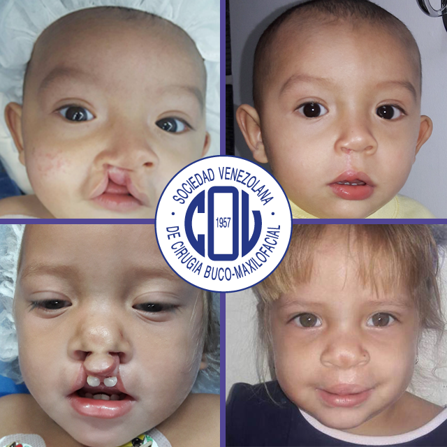 SVCBMFOficial's tweet photo. La fundación “AYUDAME A SONREÍR ROTARY CLUB ANACO” es parte de la labor social que realiza la #SVCBMF
Desde el 2012 esta Fundación ha atendido a la población afectada con Hendidura de Labio, Alvéolo y Paladar del Estado Anzoátegui. Entérate de más en
--> https://t.co/FFrxnRlmYw https://t.co/6SZkOqo5Vx