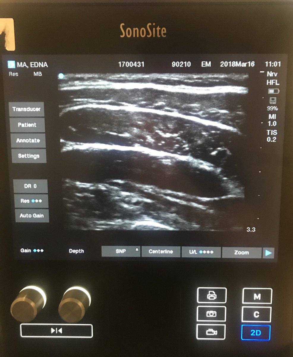 EdnaMaMD's tweet image. Been working out at @BarrysBootcamp the last few months. Check out my abs. #TAPBlock #Obliques