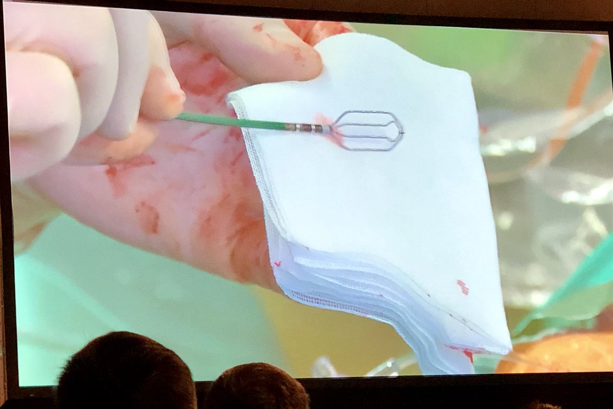 sachinjv's tweet photo. First live case with Advisor HD Grid for mapping left atrium for Afib ablation from Leipzig #EHRA2018 #Abbott @AbbottGlobal https://t.co/6sWRjNpQLZ