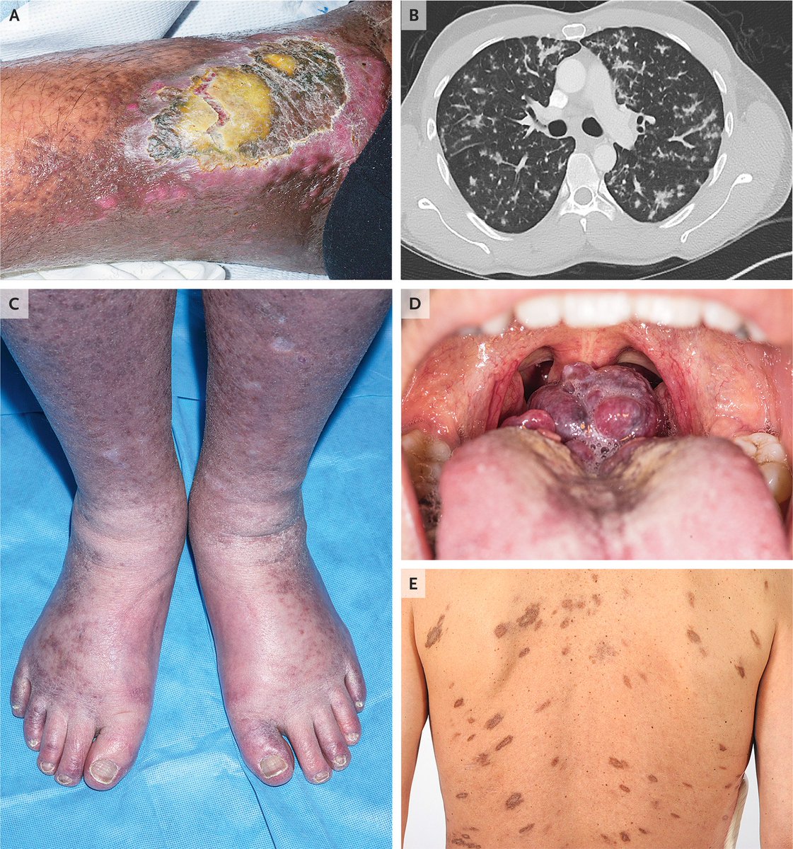 Nejm Review Article Selected Clinical Manifestations Of Kaposi S Sarcoma T Co Dg0igmijpn Hiv