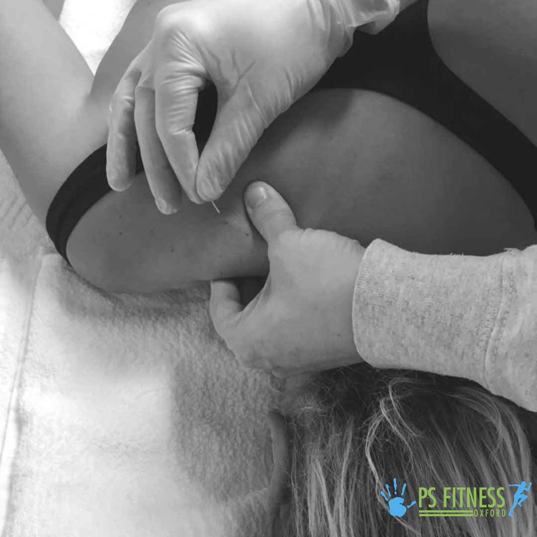 PSFITNESSOXFORD's tweet photo. 🔹Who can benefit from Dry Needling?🔹
Almost anyone experiencing:
•Acute/Chronic #injuries 
•Headaches
•Neck/#BackPain 
•#Sciatica 
•Hip/Knee pain 
•#tennis /Golfer's Elbow
•Overuse injuries
Used alongside #sportsmassage , #dryneedling can be a very effective #therapy https://t.co/fz8G22L8wz