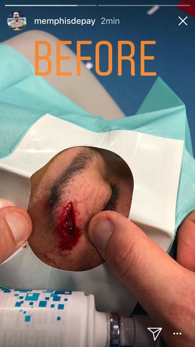 ActuFoot_'s tweet photo. La blessure de Memphis lors de son but. https://t.co/iCzcRAUT8a