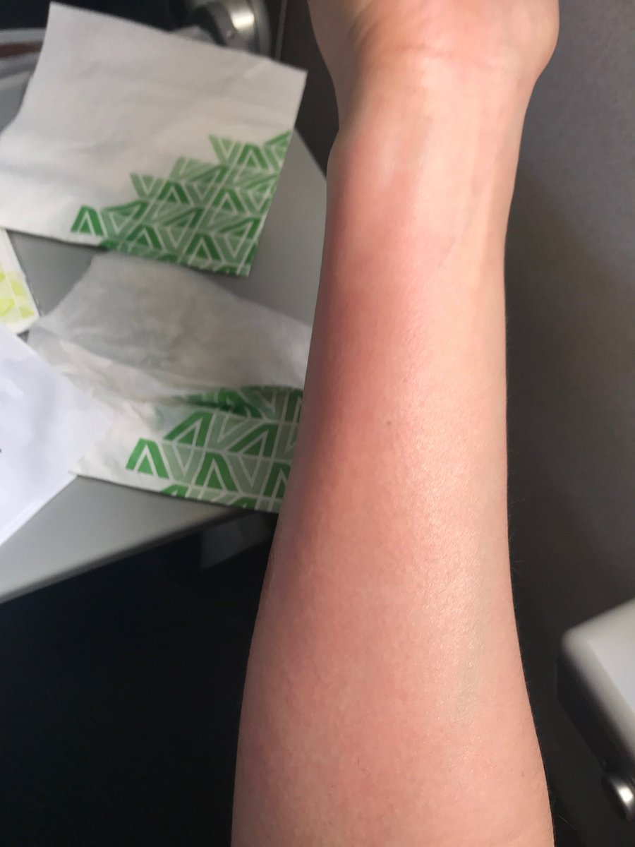 Bea_INTERPRETER's tweet photo. @Alitalia : SCALDED ON BOARD ALITALIA FLIGHT AZ217 ON THE 15TH OF MARCH!  EMAIL GIVEN TO ME PERSONALLY BY ALITALIA TO FORWARD MEDICAL REPORTS BOUNCES BACK !!! https://t.co/xtWyBxZBM3