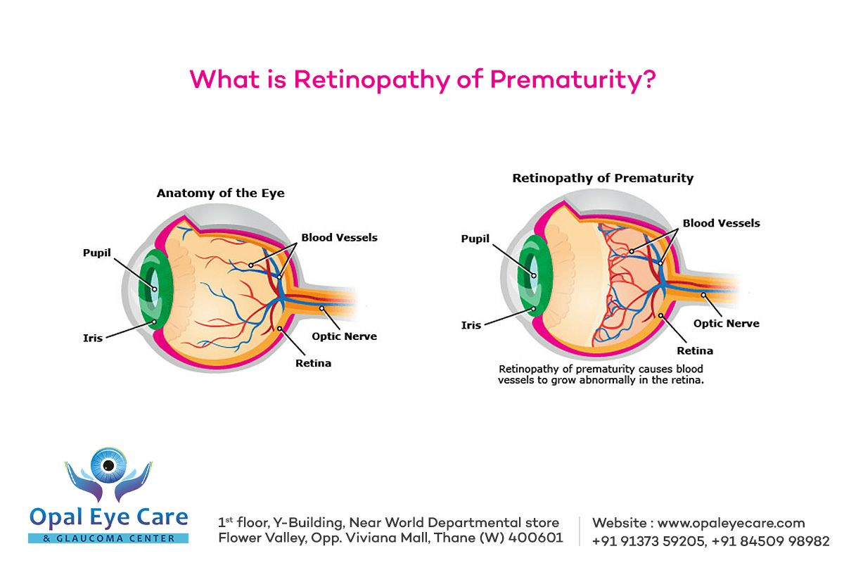 At #OpalEyeCare center we treat #RetinopathyofPrematurity (ROP) which is also known as #RetrolentalFibroplasia (RLF) or #TerrySyndrome. It is a condition that affects premature babies because of the abnormal development of the retinal blood vessels.
Read opaleyecare.wordpress.com