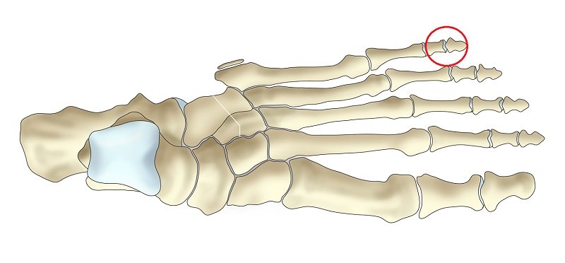 Переломы скелета. Кость мизинца на ноге перелом. Перелом кости стопы мизинец. Кости стопы человека переломы.