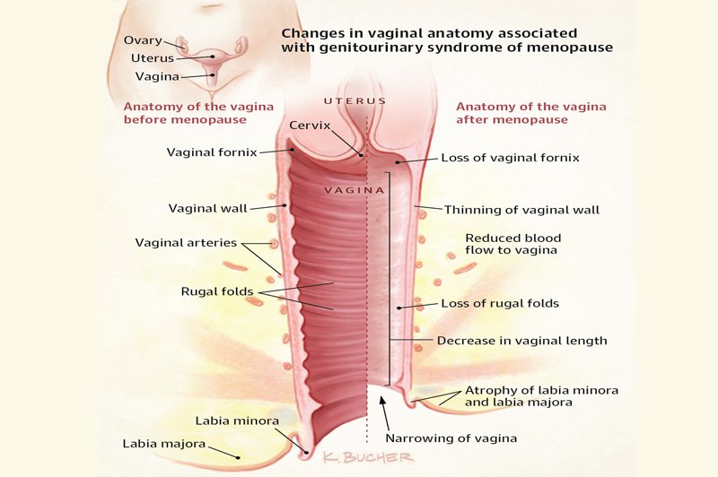 Dhea And Vaginal Dryness, Pain Pelvic Health