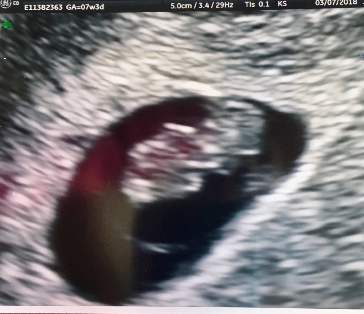 HopeSurrogacy's tweet photo. We love it when one of the surrogates in our program is excited to share her good news! Another family in the making! Have a beautiful Monday.
#surrogacy #surrogate #IVF #intendedparents #siblinglove #surrogacyagency #gestationalsurrogate #families #surrogatefamily https://t.co/Z8YGznUu4t