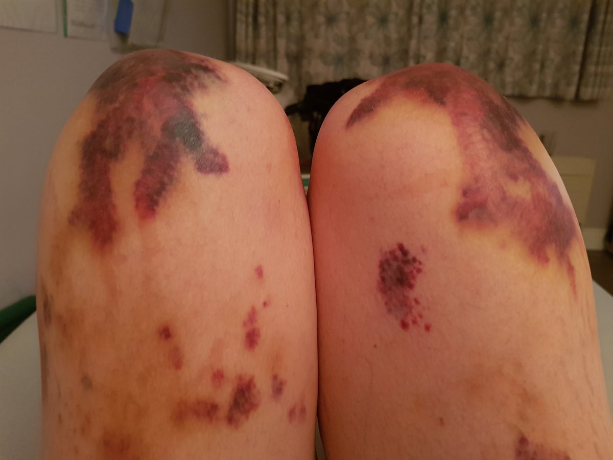 Just lost about ten minutes wondering at the state of my knees. A physical therapist said today that she'd only "seen bruises like that on trauma victims." I've got them from trying to walk.