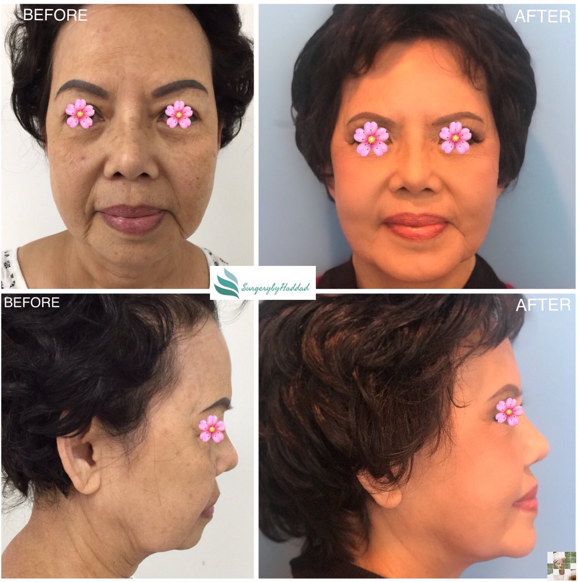 Nazih M. Haddad M.D. tweet media